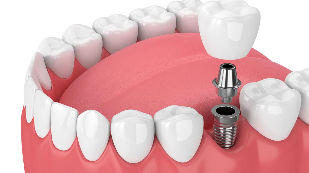 Dental Implants Naperville