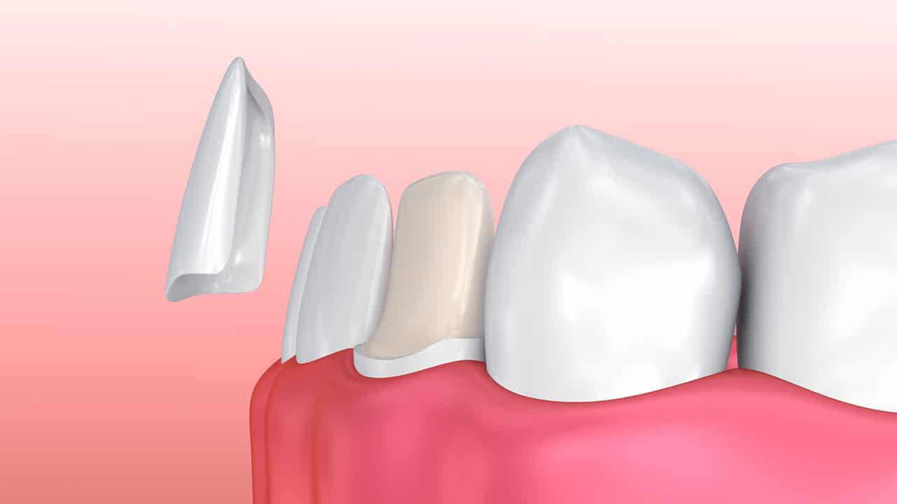 Veneers Naperville